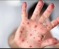 ما هو جدري القرود ولماذا عاد الآن؟